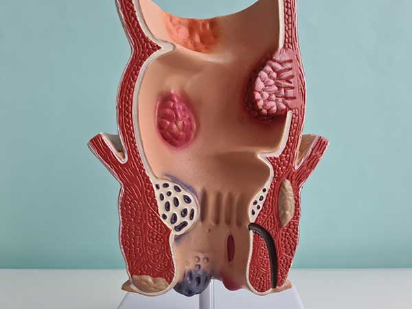 Modelo anatómico que muestra la región anal donde puede aparecer un absceso perianal